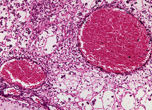 Meningococcal meningitis