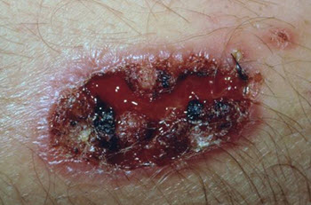 cutan Leishmaniasis